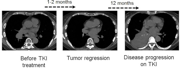 CT scan images of chest of EGFR mutant lung adenocarcinoma patient before and after treatment with Gefitinib