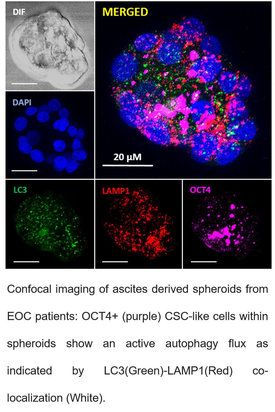 Investigating the role MAPK-ERK & PI3K-AKT signalling on autophagic flux in Ovarian Cancer Stem Cells 